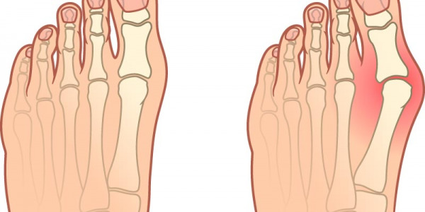 Treatment of Hallux Valgus Deformity with PRP Therapy