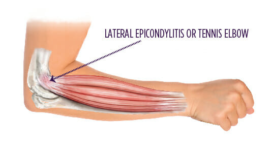 Behandlung von Tennisellenbogen (lateraler Epicondylitis) mit PRP-Therapie